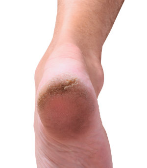 Cracked heels causes and treatment sale