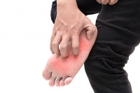 The Fungal Infection Known as Athlete’s Foot