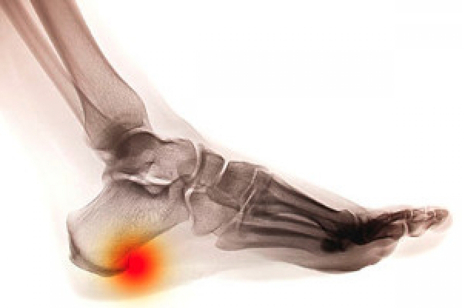 New and Effective Treatment for Heel Pain | The Podiatry Group