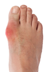 Who is Most Likely To Aquire Gout?