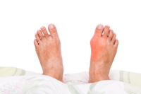 Is Gout Caused By Specific Foods?